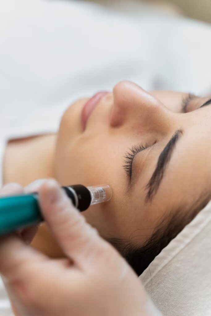 Microneedling Behandeling