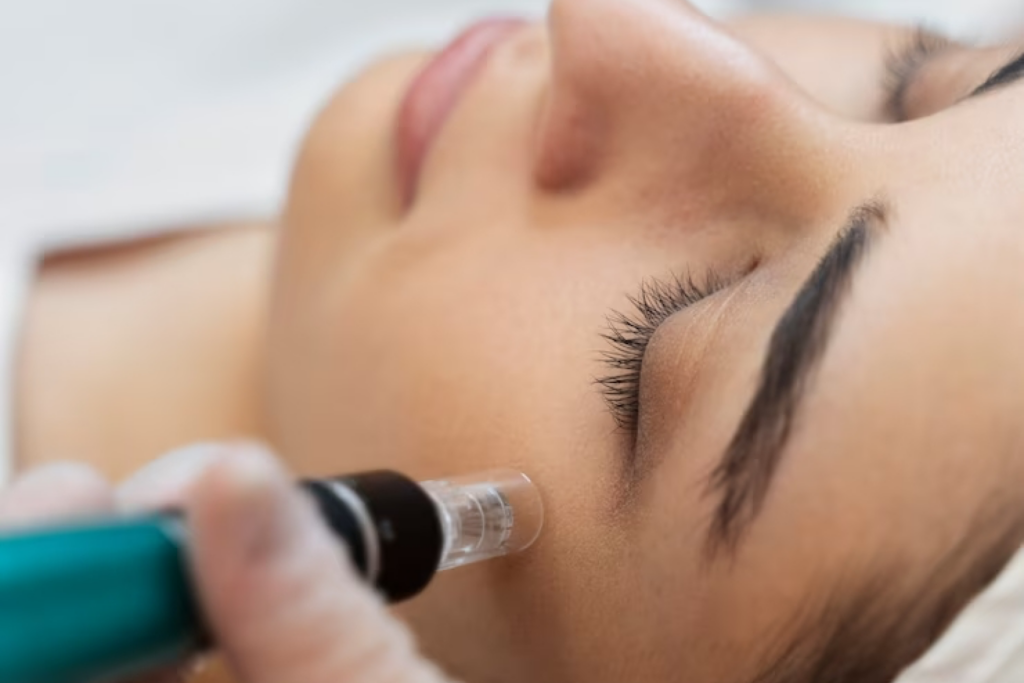 Microneedling Behandeling