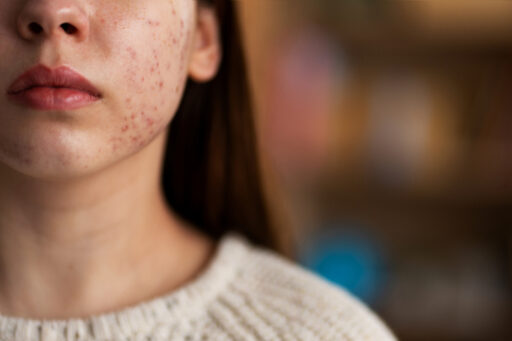 laserontharing en acne