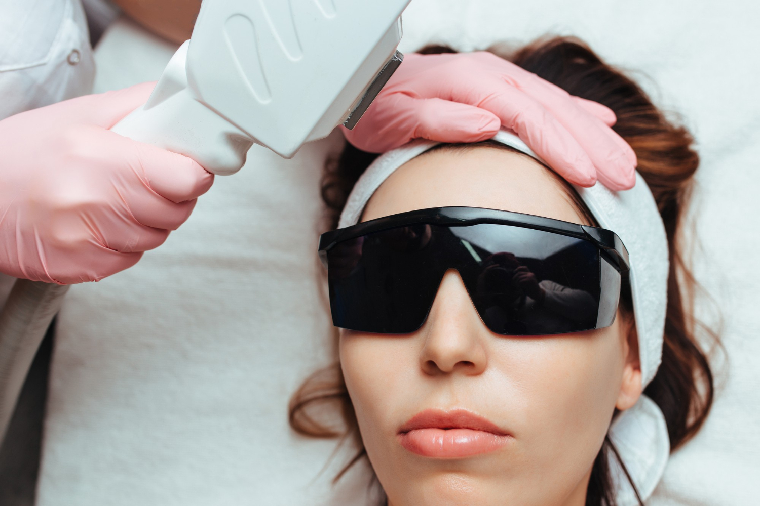 laserontharing en acne