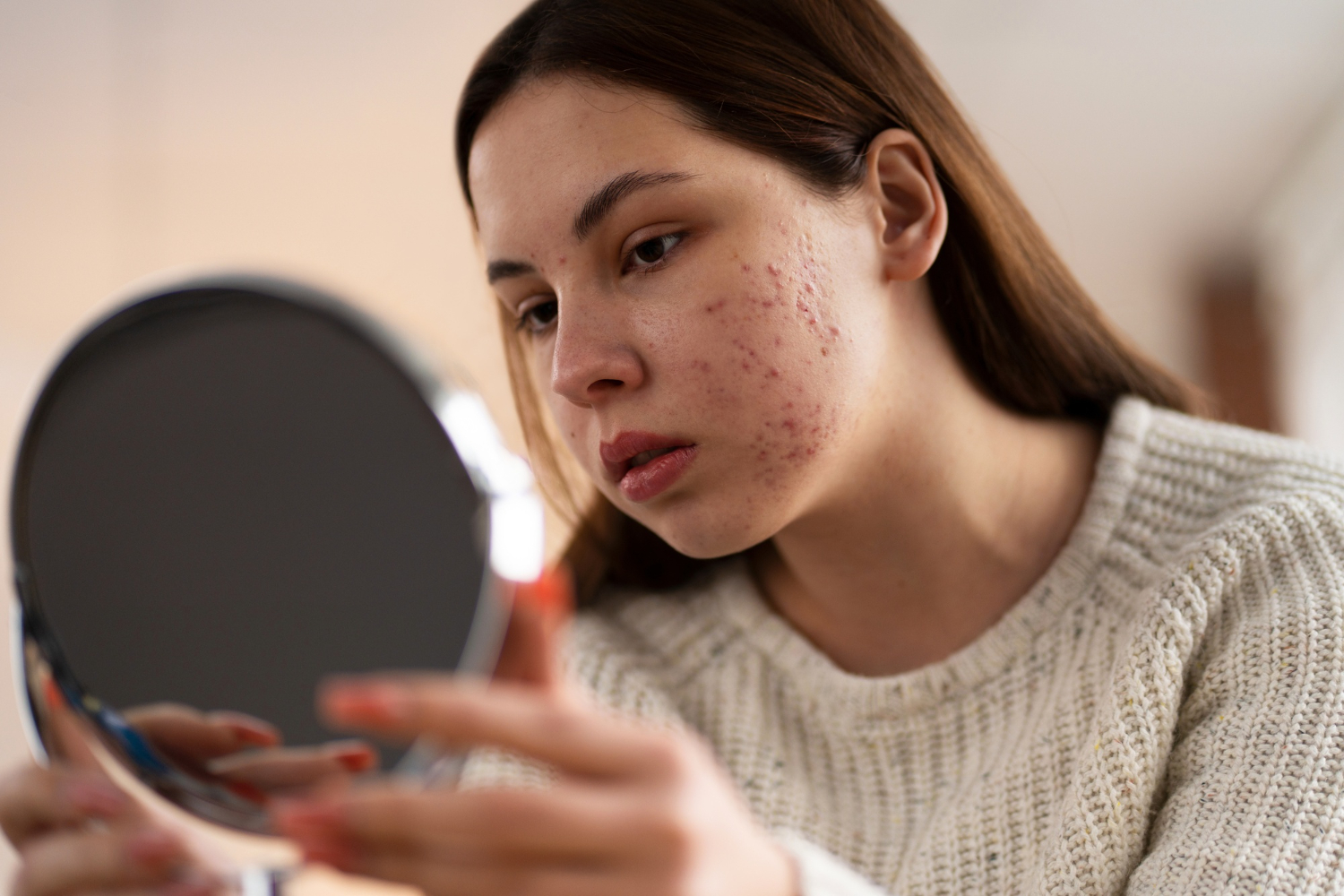 Acne littekens behandelen