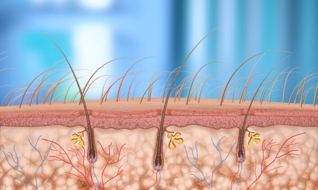 Kan laserontharing ingegroeide haren verminderen?