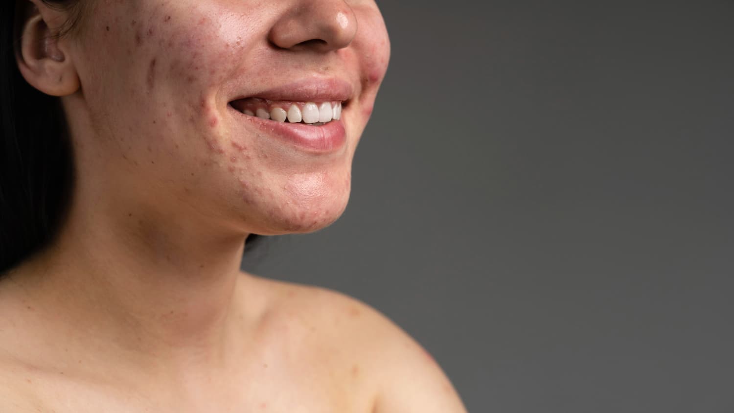 Huid met milde acne en lichte roodheid rondom kaaklijn en wangen