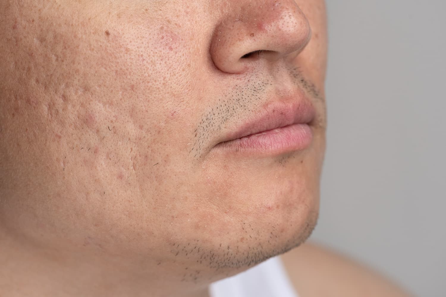 Acne littekens verminderen bij man – huidstructuur verbeteren met gerichte acne littekens behandeling