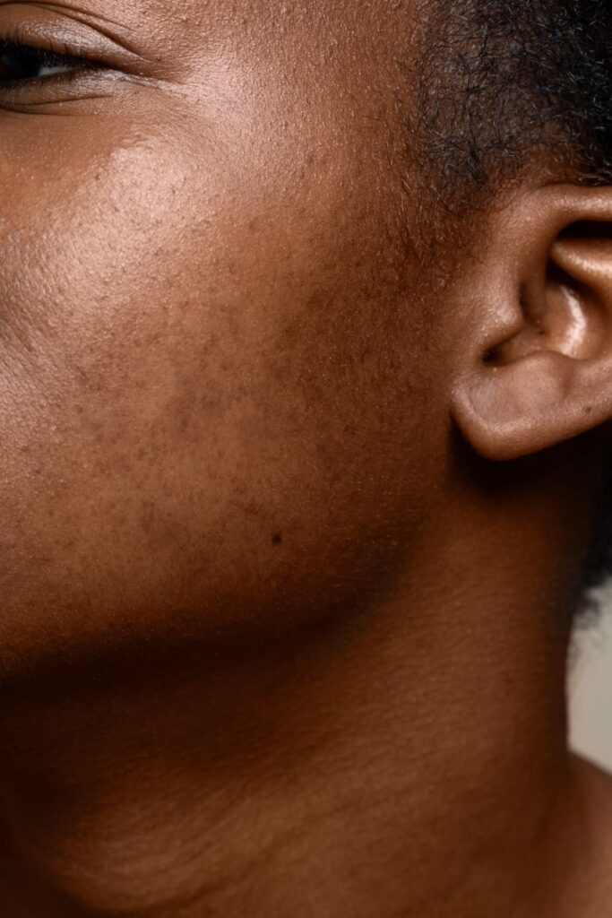 acne littekens op wang en kaaklijn zichtbaar in close-up huidstructuur