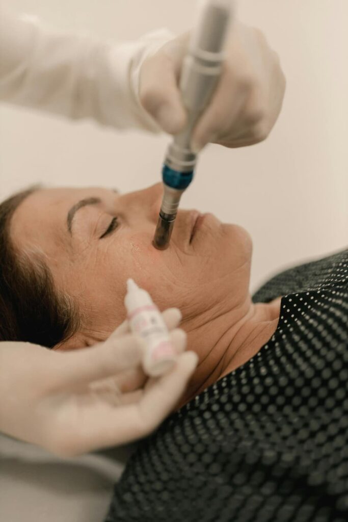 Microneedling acne littekens – effectieve behandeling acne littekens voor huidstructuur verbetering