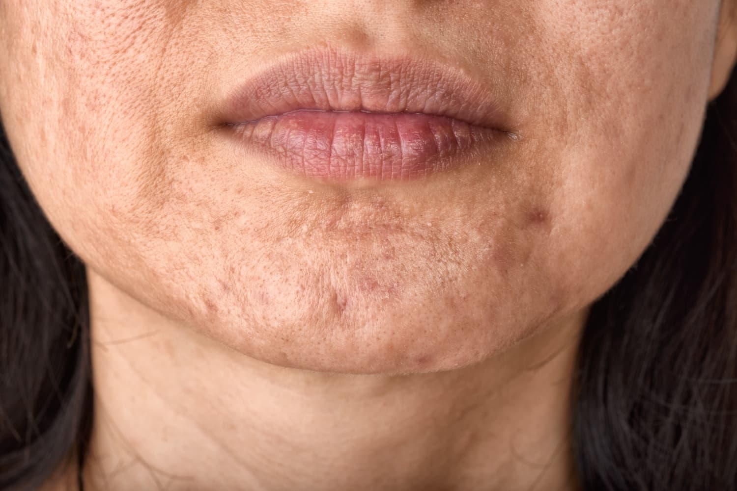 Acne littekens gezicht verminderen – zichtbare huidverbetering na acne littekens behandeling
