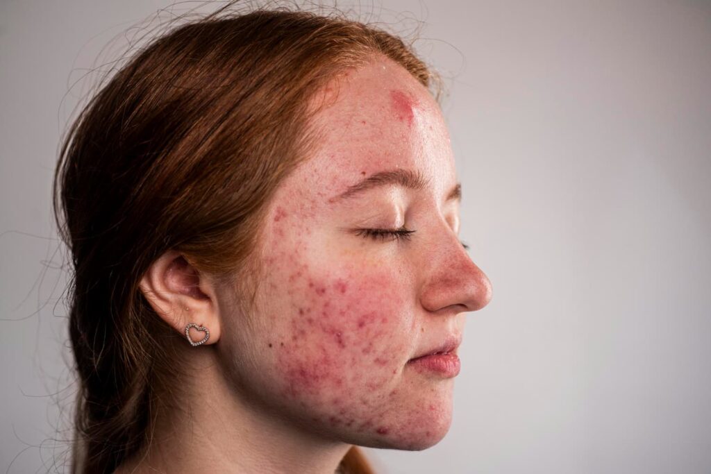 Ernstige acne op gezicht met ontstekingen, roodheid en onrustige huid zichtbaar in zijprofiel