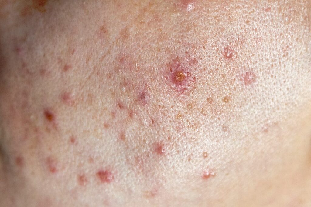 acne huid met rode ontstekingen en puistjes zichtbaar op het gezicht