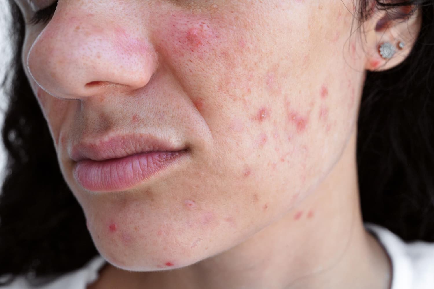 Hormonale acne behandeling huidtherapeut Alphen aan den Rijn