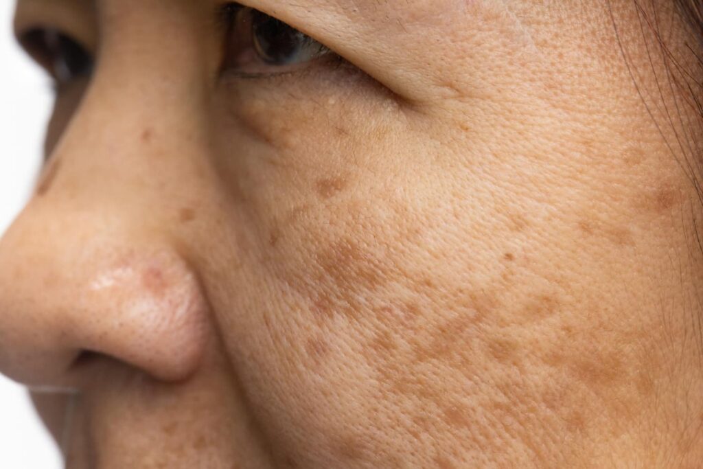 Close-up van melasma op wang en jukbeen — hardnekkige bruine pigmentvlekken in het gezicht