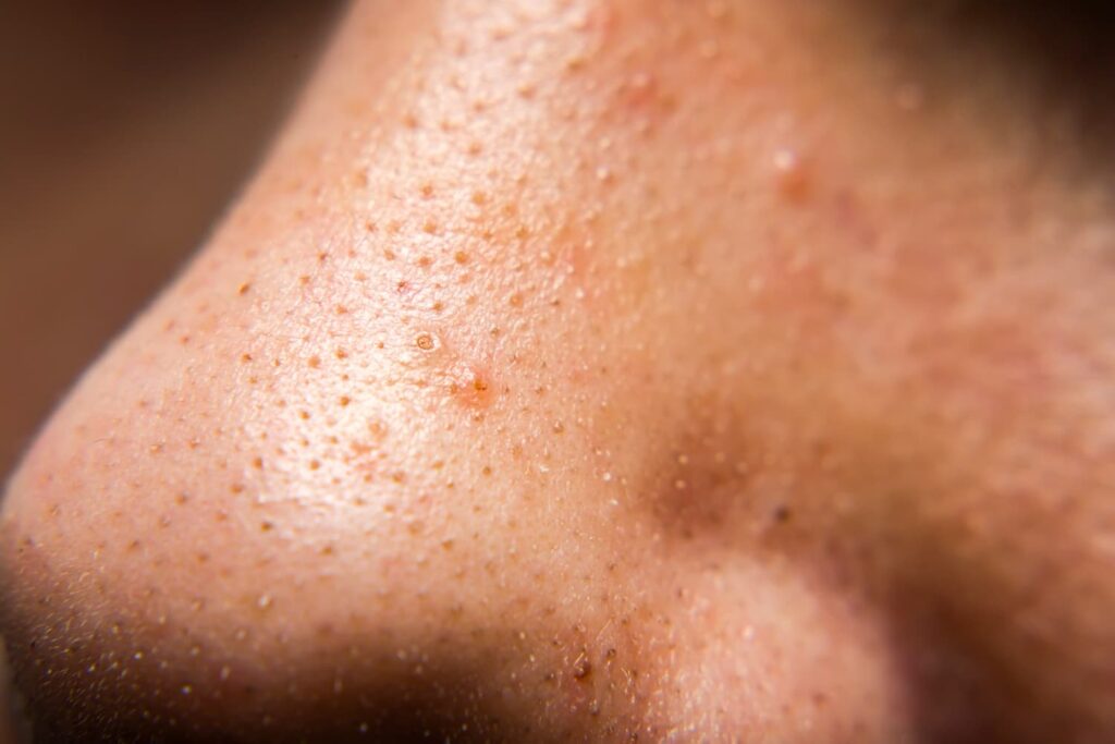 Extreme close-up van comedonen op neus — hardnekkige mee-eters als veelvoorkomend huidprobleem