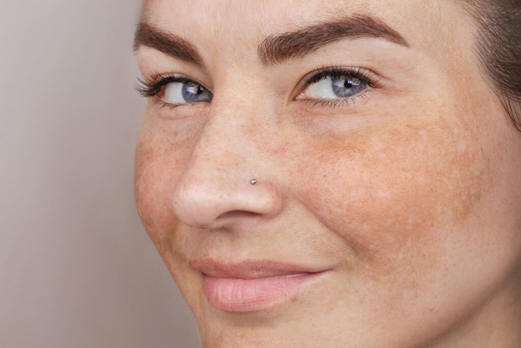 Melasma behandeling bij huidtherapeut in Alphen aan den Rijn — zichtbare pigmentvlekken op wang en neus