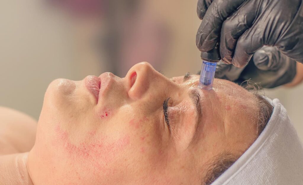 Close-up microneedling behandeling op voorhoofd met lichte roodheid
Microneedling behandeling op voorhoofd en wang — huidtherapeut in de buurt van Den Haag