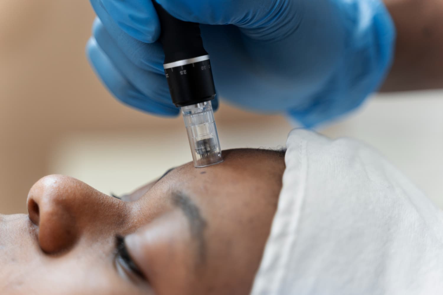 Microneedling-behandeling van het gelaat bij de huidtherapeut