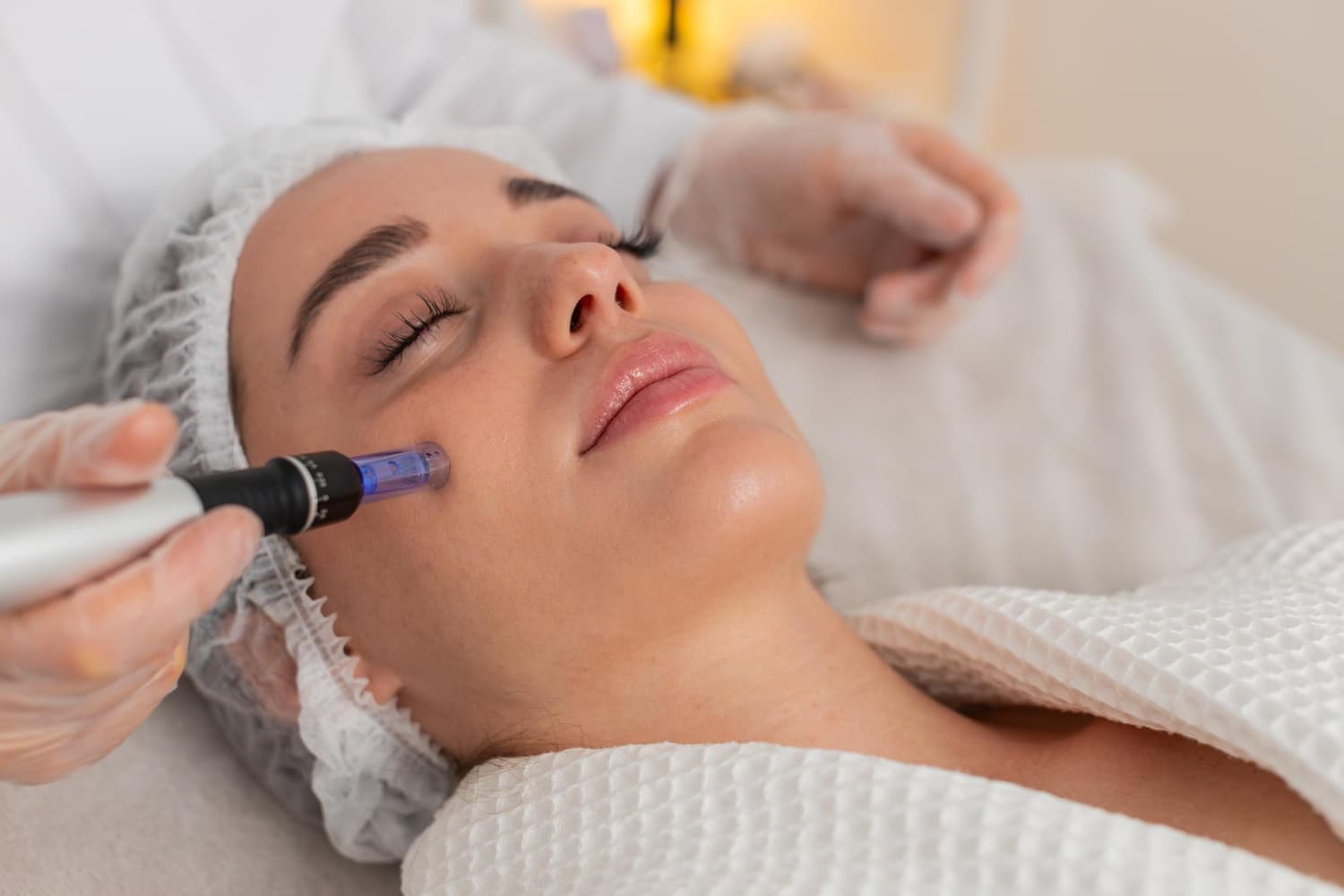 Close-up van een microneedling-behandeling in het gezicht