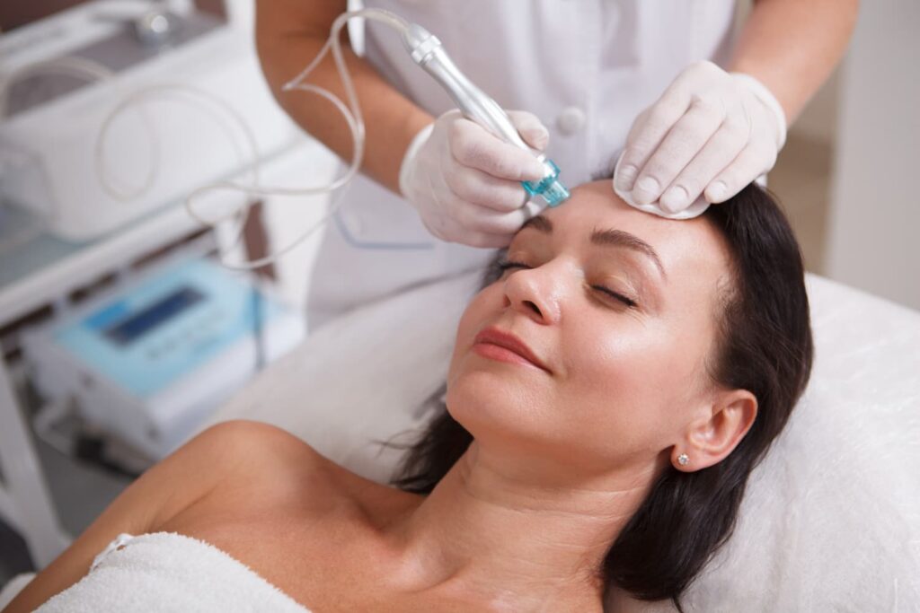 Huidtherapeut past microneedling toe op voorhoofd bij cliënte Microneedling op voorhoofd door ervaren huidtherapeut — microneedling Den Haag bij Huidtherapie van den Berg
