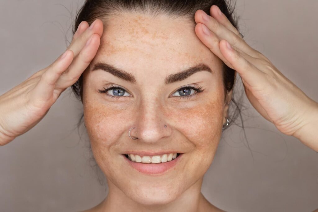 Vrouw met zichtbare melasma op voorhoofd en wangen — onegale pigmentatie die behandeling vraagt