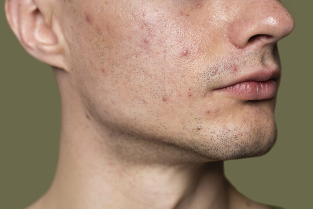 Acne bij mannen behandelen bij Huidtherapie van den Berg