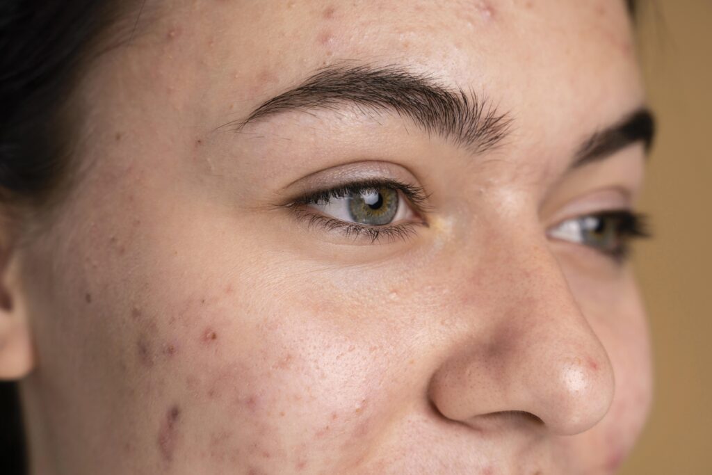 Cysteuze acne behandelen bij Huidtherapie van den Berg