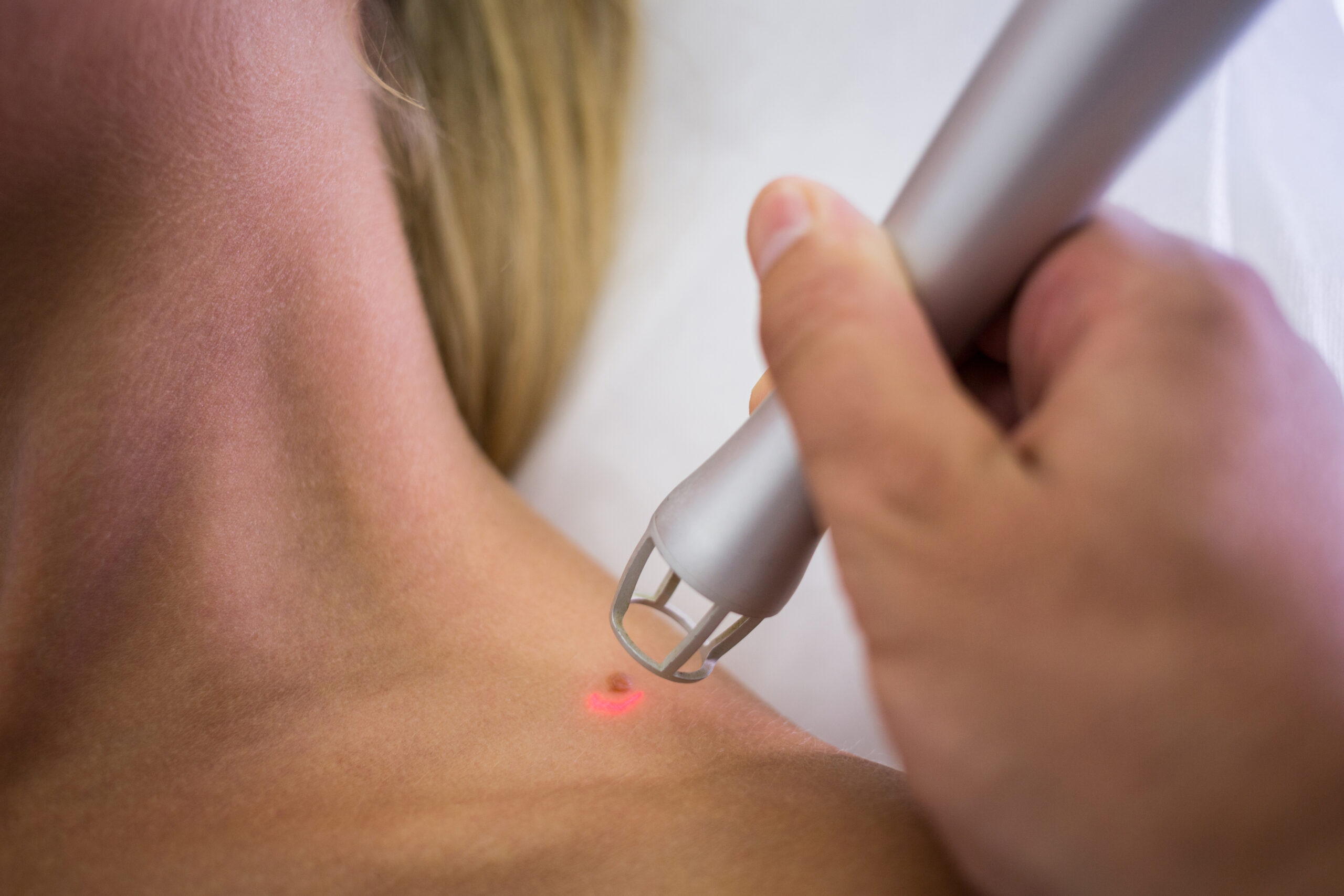 Elektrocoagulatie van een steelwratje bij Huidtherapie van den Berg