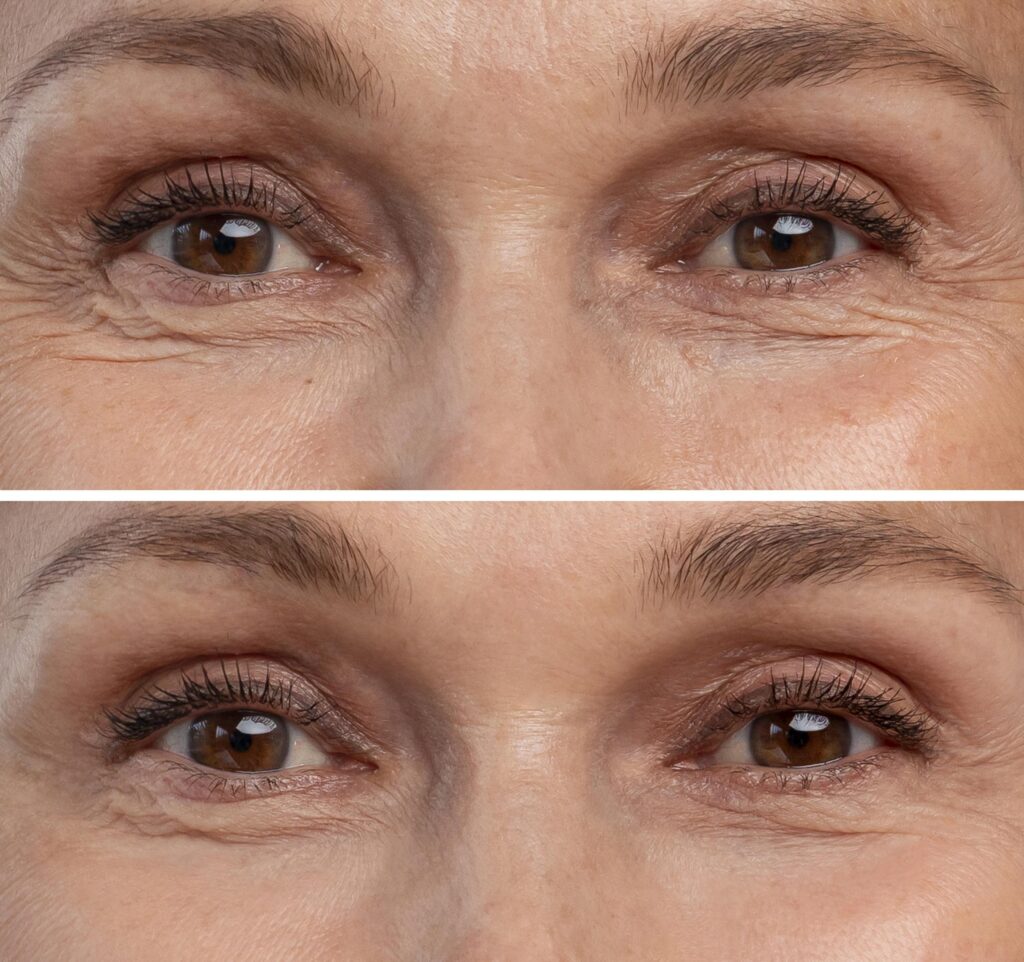 Anti-aging behandeling tegen fijne lijntjes in de praktijk
