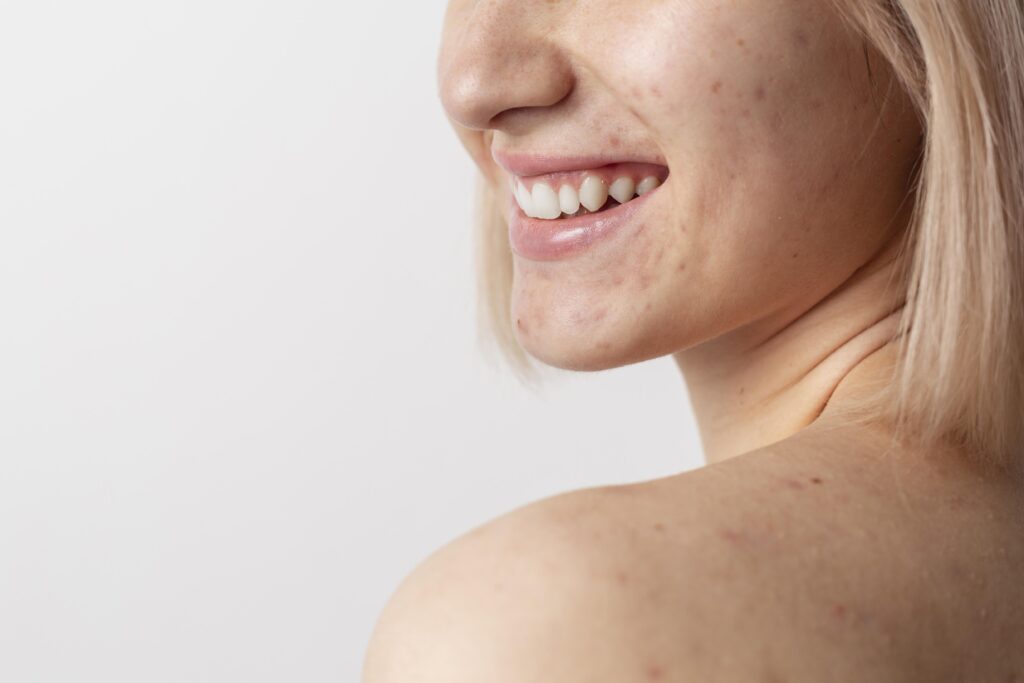 Hormonale acne behandelen bij Huidtherapie van den Berg