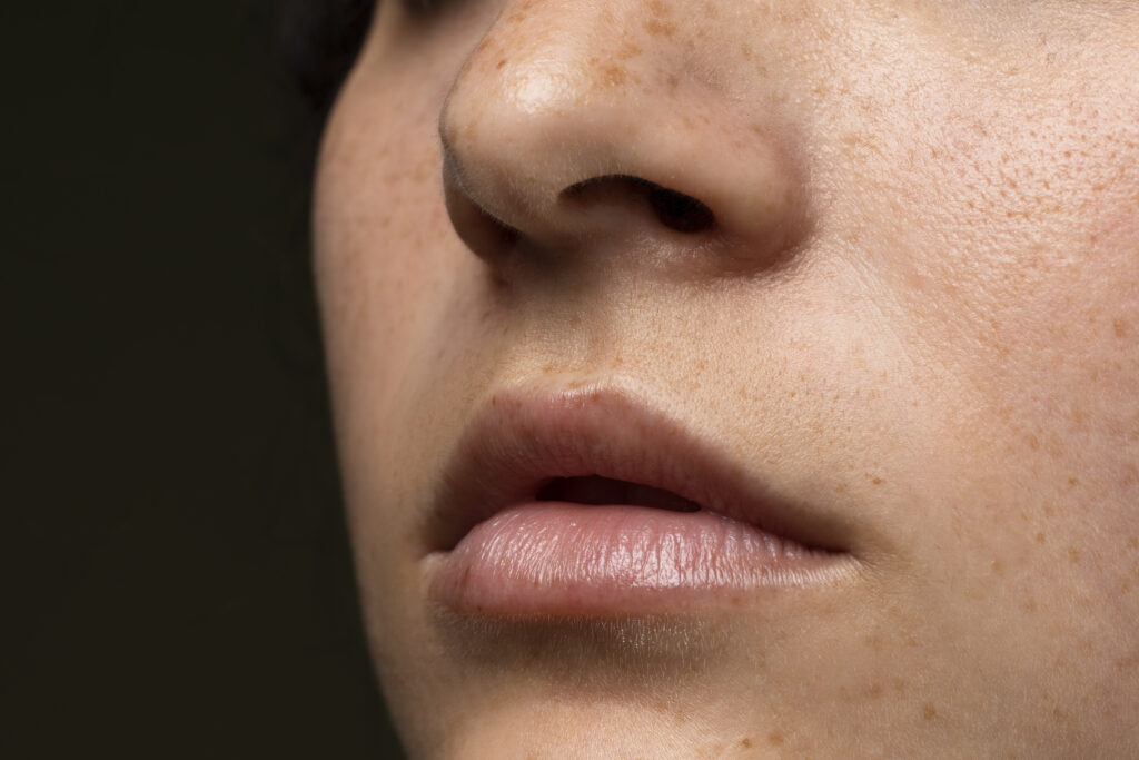 De huid egaliseren na acne