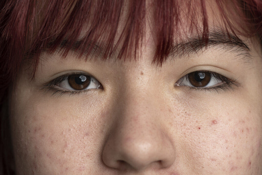Huidverzorging bij pigmentvlekken na acne