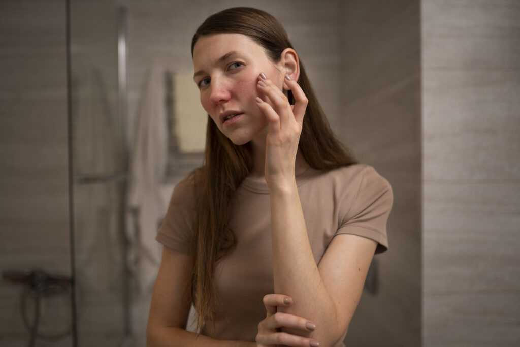 Rosacea behandelen bij Huidtherapie van den Berg