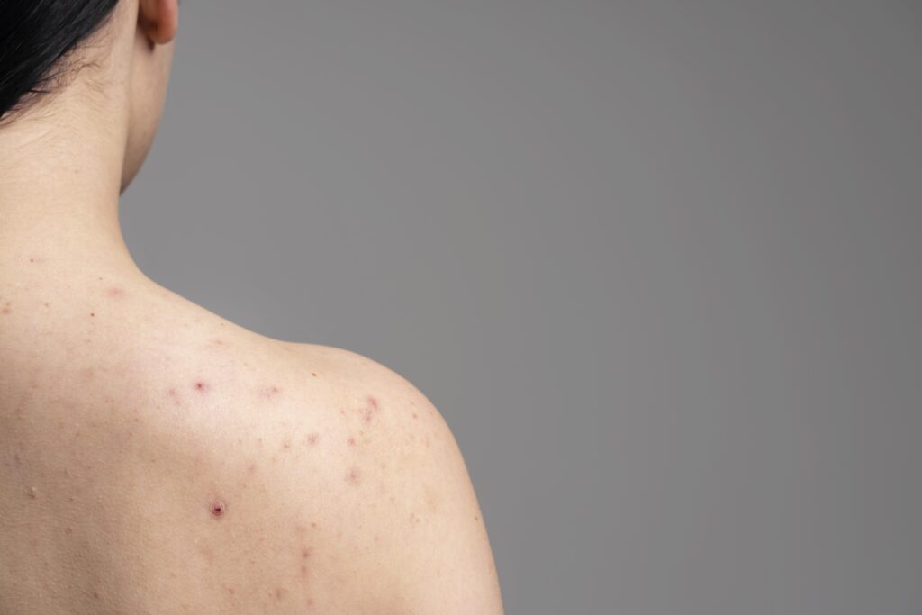 Rugacne behandelen bij Huidtherapie van den Berg