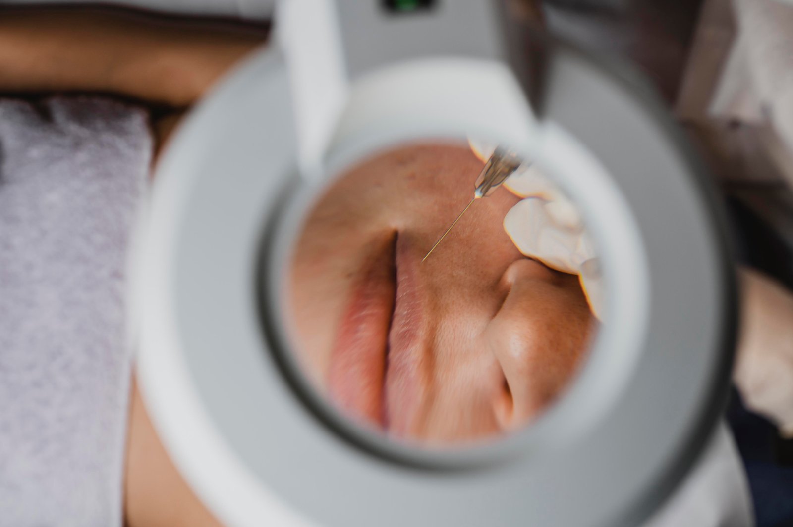 Acnebehandeling bij Huidtherapie van den Berg